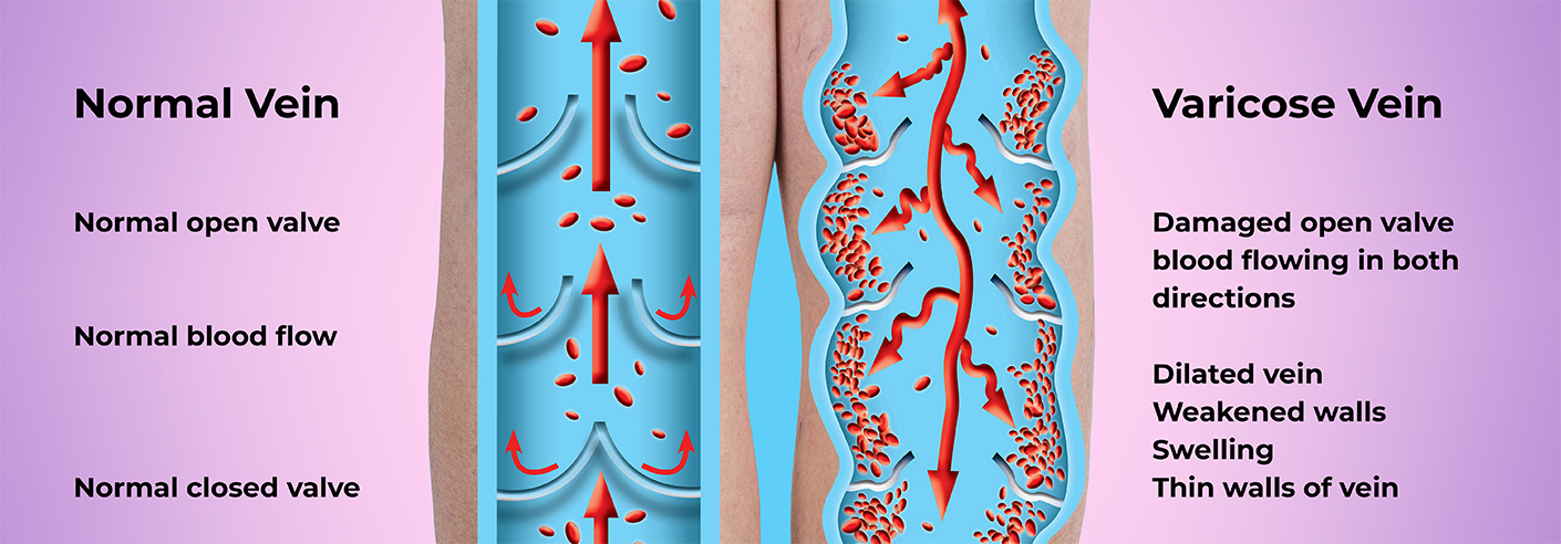 Left: normal vein and blood flow. Right: Varicose (damaged) vein and blood flow.