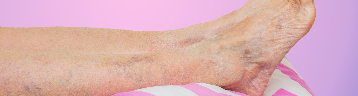 Varicose Veins in leg and foot
